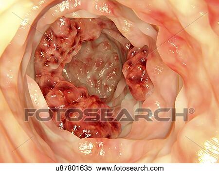 Colon cancer, artwork View Large Illustration Stock Illustration - Colon cancer, artwork. Fotosearch