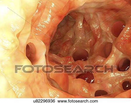Diverticula in colon, artwork View Large Illustration Stock Illustration - Diverticula in colon, artwork. Fotosearch