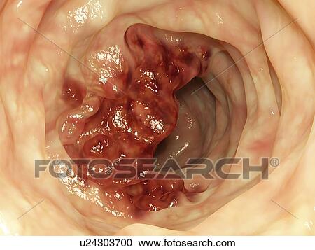 Intestinal tumor, artwork View Large Illustration Clipart - Intestinal tumor, artwork. Fotosearch