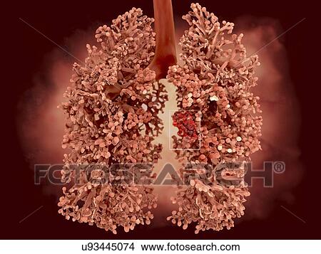 Lung cancer, artwork View Large Illustration Stock Illustration - Lung cancer, artwork. Fotosearch