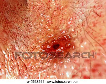Peptic ulcer, artwork View Large Illustration Clip Art - Peptic ulcer, artwork. Fotosearch