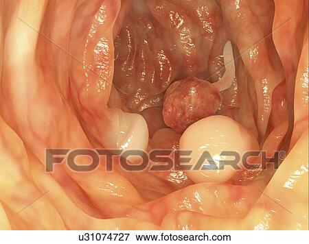 Polyps in colon, artwork View Large Illustration Stock Illustration - Polyps in colon, artwork. Fotosearch