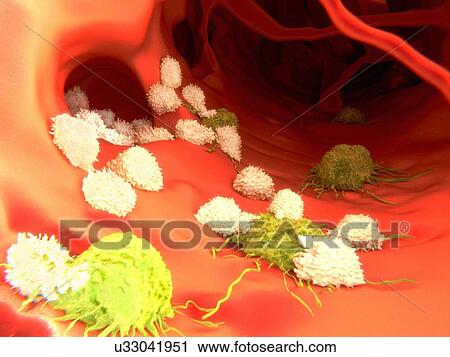 Clip Art - T-lymphocytes and cancer cells, artwork. Fotosearch