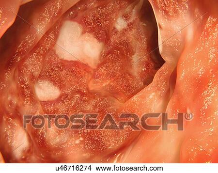 Ulcerative colitis, artwork View Large Illustration Stock Illustration - Ulcerative colitis, artwork. Fotosearch