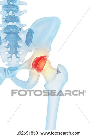Clipart - Human hip joint, artwork. Fotosearch