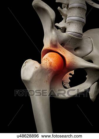 Human hip joint, artwork View Large Illustration Stock Illustration - Human hip joint, artwork. Fotosearch