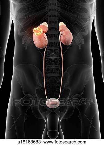 Drawing - Human kidney with cancer, artwork. Fotosearch