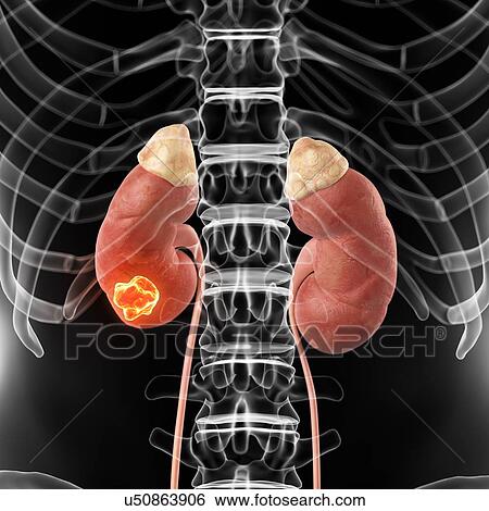Human kidney with cancer, artwork View Large Illustration Stock Illustration - Human kidney with cancer, artwork. Fotosearch