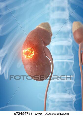 Human kidney with cancer, artwork View Large Illustration Stock Illustration - Human kidney with cancer, artwork. Fotosearch