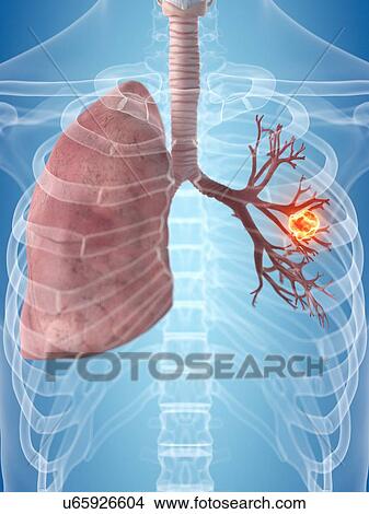 Stock Illustration - Human lungs, artwork. Fotosearch
