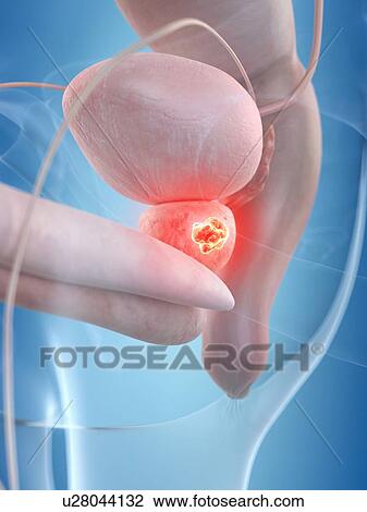 Human prostate tumor, artwork View Large Illustration Drawing - Human prostate tumor, artwork. Fotosearch