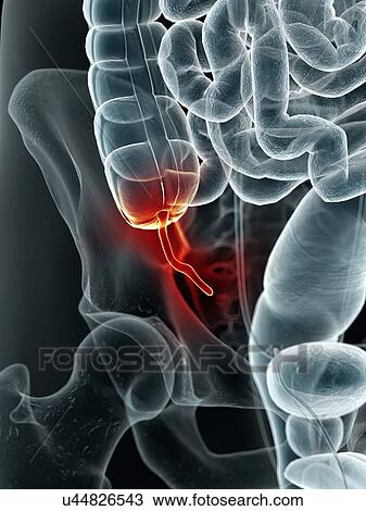 Drawing - Inflamed appendix, artwork. Fotosearch