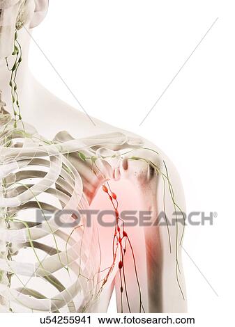 Clip Art - Inflamed lymph nodes, artwork. Fotosearch