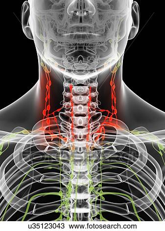 Inflamed lymph nodes, artwork View Large Illustration Drawing - Inflamed lymph nodes, artwork. Fotosearch