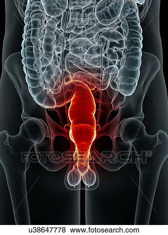 Inflamed rectum, artwork View Large Illustration Stock Illustration - Inflamed rectum, artwork. Fotosearch