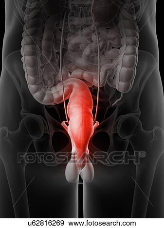 Stock Illustration - Inflamed rectum, artwork. Fotosearch