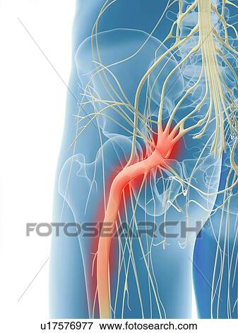 Inflamed sciatic nerve, artwork View Large Illustration Stock Illustration - Inflamed sciatic nerve, artwork. Fotosearch