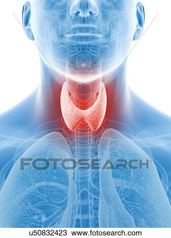 Inflamed thyroid, artwork View Large Illustration Drawing - Inflamed thyroid, artwork. Fotosearch