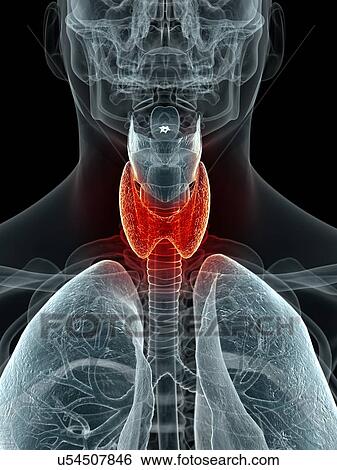 Inflamed thyroid, artwork View Large Illustration Stock Illustration - Inflamed thyroid, artwork. Fotosearch