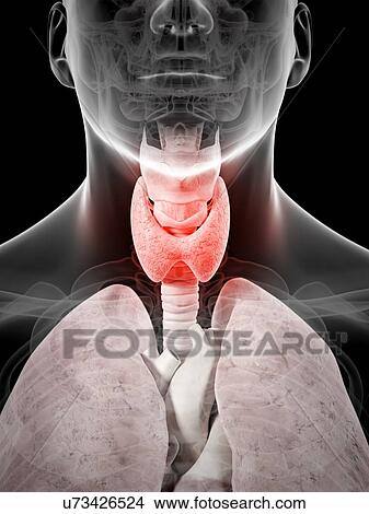Stock Illustration - Inflamed thyroid, artwork. Fotosearch