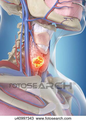 Drawing - Tumor in human thyroid, artwork. Fotosearch