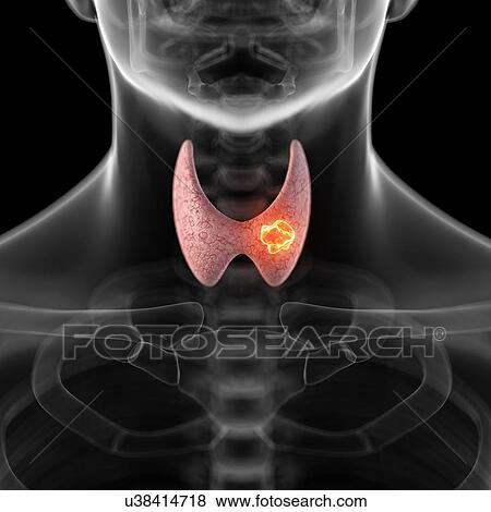 Tumor in human thyroid, artwork View Large Illustration Stock Illustration - Tumor in human thyroid, artwork. Fotosearch