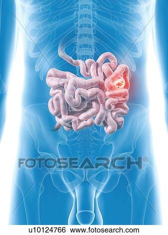 Tumor in small intestine, artwork View Large Illustration Stock Illustration - Tumor in small intestine, artwork. Fotosearch