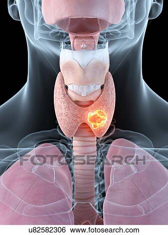 Tumor in thyroid, artwork View Large Illustration Stock Illustration - Tumor in thyroid, artwork. Fotosearch