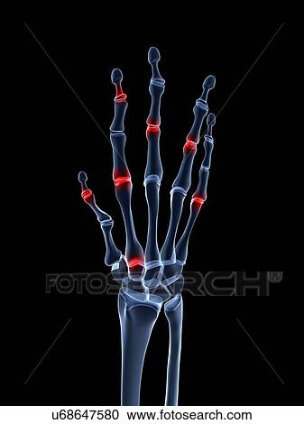 Arthritic hand, artwork View Large Illustration Clipart - Arthritic hand, artwork. Fotosearch