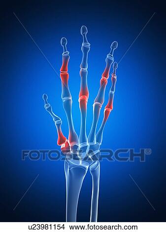 Arthritic hand, artwork View Large Illustration Stock Illustration - Arthritic hand, artwork. Fotosearch