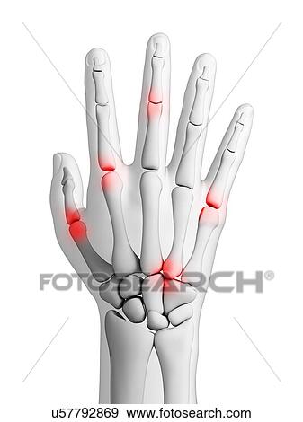 Arthritic hand, artwork View Large Illustration Stock Illustration - Arthritic hand, artwork. Fotosearch