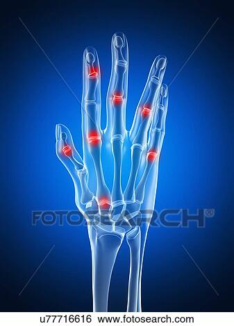 Stock Illustration - Arthritic hand, artwork. Fotosearch
