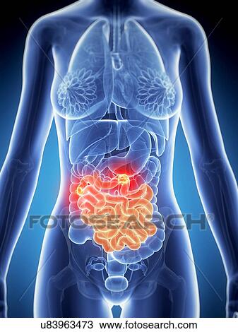 Female bowl cancer, artwork View Large Illustration Drawing - Female bowl cancer, artwork. Fotosearch
