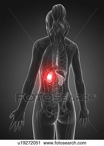 Female kidney failure, artwork View Large Illustration Clip Art - Female kidney failure, artwork. Fotosearch