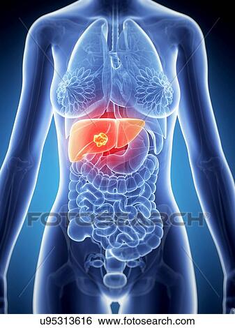 Stock Illustration - Female liver cancer, artwork. Fotosearch