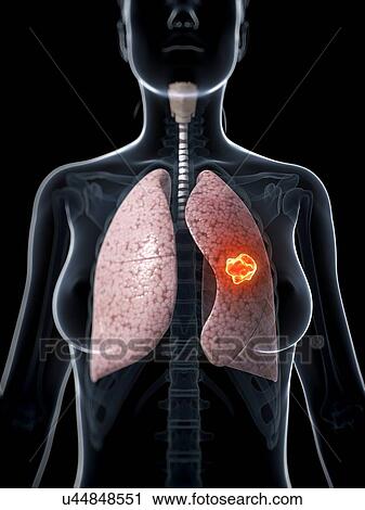 Clip Art - Female lung cancer, artwork. Fotosearch