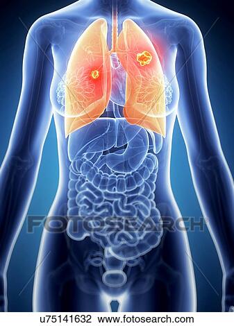 Female lung cancer, artwork View Large Illustration Drawing - Female lung cancer, artwork. Fotosearch