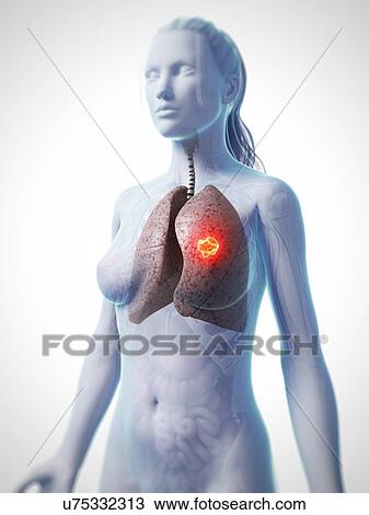 Female lung cancer, artwork View Large Illustration Drawing - Female lung cancer, artwork. Fotosearch