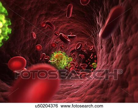 HIV infection, artwork View Large Illustration Stock Illustration - HIV infection, artwork. Fotosearch