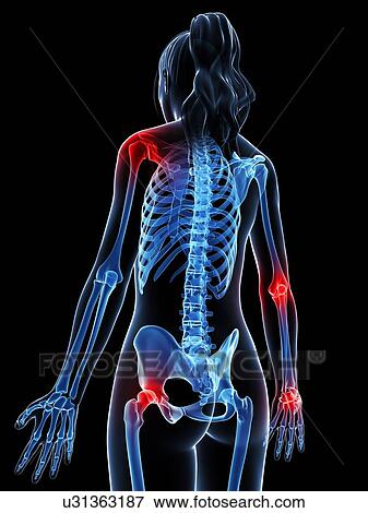 Stock Illustration - Human anatomy of inflamed joints, artwork. Fotosearch