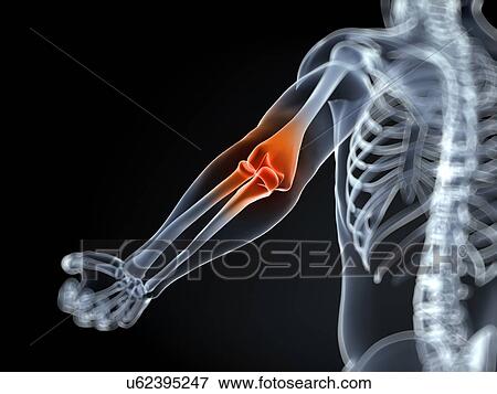 Human elbow joint pain, artwork View Large Illustration Stock Illustration - Human elbow joint pain, artwork. Fotosearch