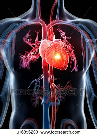 Clipart - Human heart attack, artwork. Fotosearch