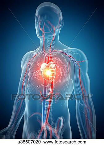 Clipart - Human heart attack, artwork. Fotosearch