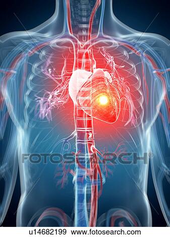 Human heart attack, artwork View Large Illustration Stock Illustration - Human heart attack, artwork. Fotosearch