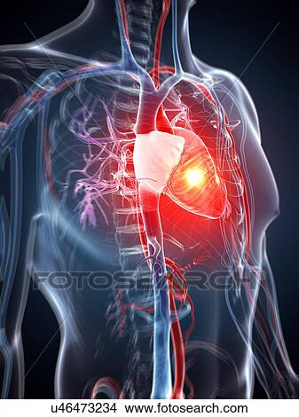 Human heart attack, artwork View Large Illustration Stock Illustration - Human heart attack, artwork. Fotosearch