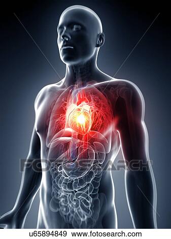 Stock Illustration - Human heart attack, artwork. Fotosearch