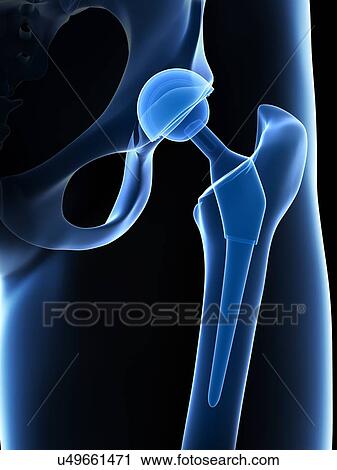 Human hip replacement, artwork View Large Illustration Clip Art - Human hip replacement, artwork. Fotosearch