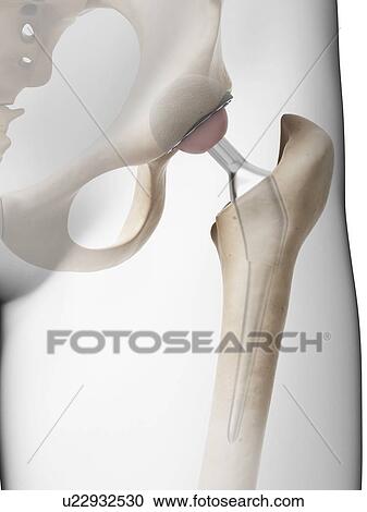 Human hip replacement, artwork View Large Illustration Clipart - Human hip replacement, artwork. Fotosearch