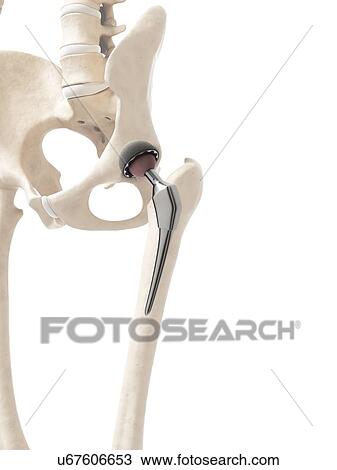 Human hip replacement, artwork View Large Illustration Drawing - Human hip replacement, artwork. Fotosearch