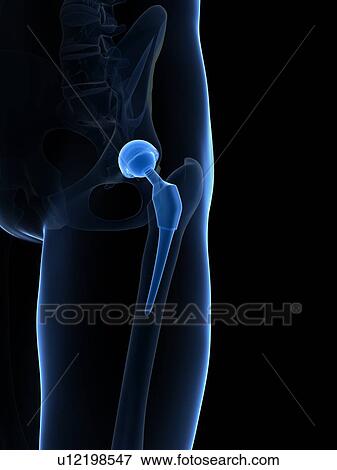 Stock Illustration - Human hip replacement, artwork. Fotosearch